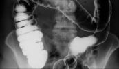 Chụp đại trực tràng với thuốc xổ Barium: ý nghĩa lâm sàng kết quả