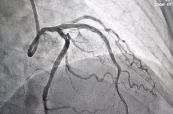 Chụp động mạch vành (Angiograms)