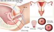Soi cổ tử cung và sinh thiết cổ tử cung: ý nghĩa lâm sàng giá trị kết quả