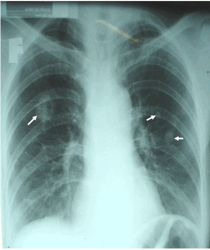 Bệnh bụi phổi (Silicosis) trên phim x quang