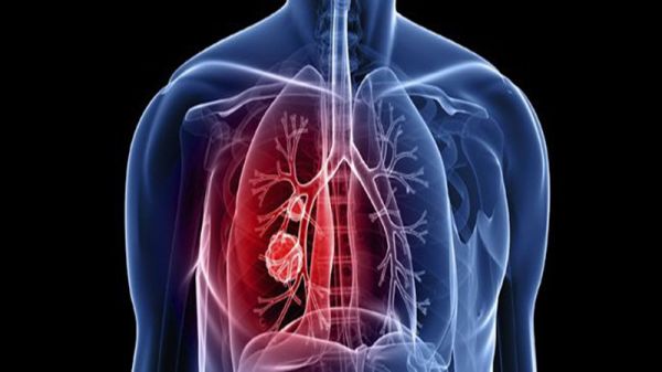 Chụp động mạch phổi: ý nghĩa lâm sàng kết quả