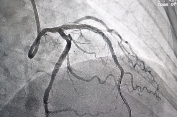 Chụp động mạch vành (Angiograms)