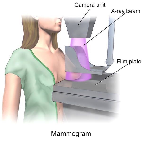 Chụp X quang tuyến vú: ý nghĩa lâm sàng giá trị kết quả