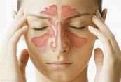Bệnh viêm mũi dị ứng - Triệu chứng, nguyên nhân và cách điều trị