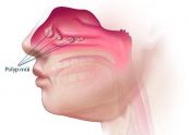 Bệnh polyp mũi - Triệu chứng, nguyên nhân và cách điều trị