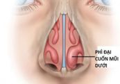 Bệnh phì đại cuống mũi - Triệu chứng, nguyên nhân và cách điều trị