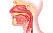Bệnh viêm mũi họng - Triệu chứng, nguyên nhân và cách điều trị