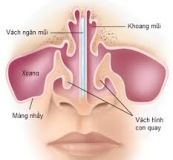 Bệnh viêm mũi vận mạch - Triệu chứng, nguyên nhân và cách điều trị