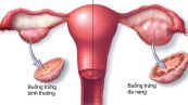 Hội chứng buồng trứng đa nang - Triệu chứng, nguyên nhân và cách điều trị