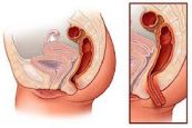 Bệnh sa tử cung (Sa sinh dục) - Triệu chứng, nguyên nhân và cách điều trị