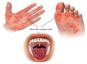 Bệnh tay chân miệng - Triệu chứng, nguyên nhân và cách điều trị