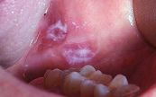Hội chứng liken phẳng ở miệng - Triệu chứng, nguyên nhân và cách điều trị