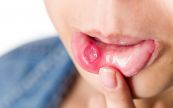 Bệnh loét miệng  - Triệu chứng, nguyên nhân và cách điều trị