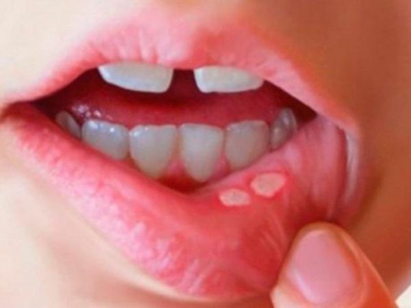 Bệnh nhiệt miệng - triệu chứng, nguyên nhân và cách điều trị