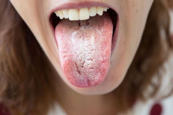 Hội chứng nấm candida miệng - Triệu chứng, nguyên nhân và cách điều trị