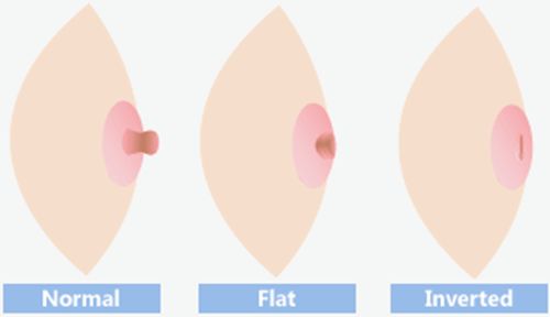 Bệnh tụt núm vú - Triệu chứng, nguyên nhân và cách điều trị