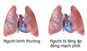 Bệnh tăng huyết áp phổi - Triệu chứng, nguyên nhân và cách điều trị