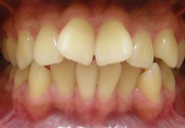 Răng khấp khểnh - Triệu chứng, nguyên nhân và cách điều trị