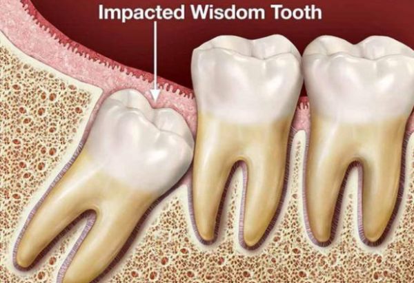 Răng khôn - Triệu chứng, nguyên nhân và cách điều trị