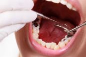Sâu răng - Triệu chứng, nguyên nhân và cách điều trị