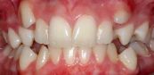 Mọc thừa răng - Triệu chứng, nguyên nhân và cách điều trị