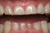 Hội chứng mòn răng - Triệu chứng, nguyên nhân và cách điều trị
