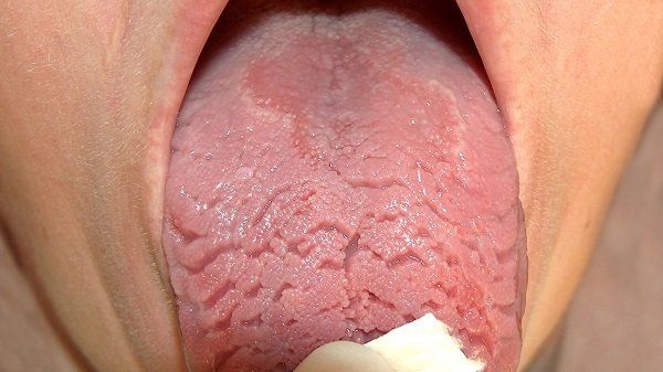 Hội chứng nứt lưỡi - Triệu chứng, nguyên nhân và cách điều trị
