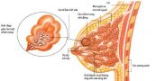 Bệnh ung thư biểu mô tiểu thùy xâm lấn - Triệu chứng, nguyên nhân và cách điều trị