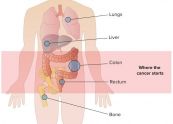 Hội chứng ung thư di căn - Triệu chứng, nguyên nhân và cách điều trị