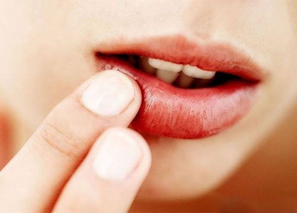 Bệnh ung thư môi - Triệu chứng, nguyên nhân và cách điều trị