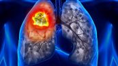 Bệnh bụi phổi amiăng - Triệu chứng, nguyên nhân và cách điều trị