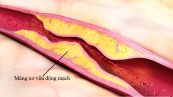 Bệnh xơ cứng động mạch - Triệu chứng, nguyên nhân và cách điều trị