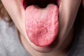 Bệnh viêm lưỡi - Triệu chứng, nguyên nhân và cách điều trị