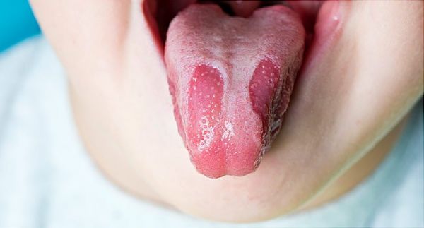 Bệnh lưỡi bản đồ - Triệu chứng, nguyên nhân và cách điều trị
