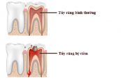 Bệnh viêm tủy răng - Triệu chứng, nguyên nhân và cách điều trị