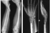 Bệnh gãy xương cánh tay - Triệu chứng, nguyên nhân và cách điều trị
