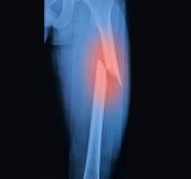 Bệnh gãy xương chày - Triệu chứng, nguyên nhân và cách điều trị