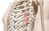 Bệnh gãy xương sườn - Triệu chứng, nguyên nhân và cách điều trị