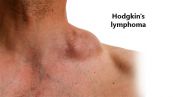 Hodgkin - Triệu chứng, nguyên nhân và cách điều trị