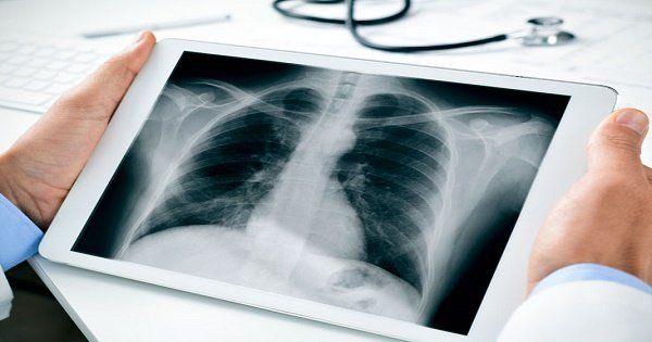 Chụp X-quang chi - Quy trình thực hiện và những lưu ý cần biết