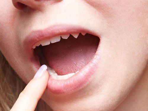 Bệnh cứng lưỡi - Triệu chứng, nguyên nhân và cách điều trị